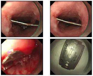 男子口吞刀片险要开胸.