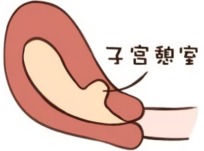 子宫瘢痕憩室(—)_剖宫产