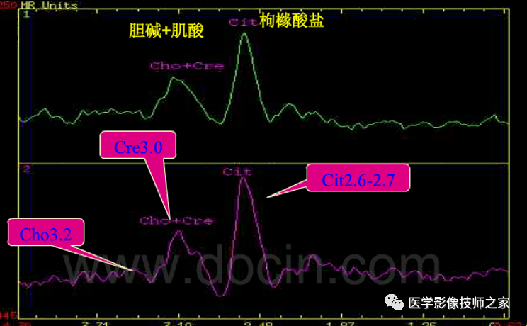 一文读懂!磁共振波普(mrs)检查