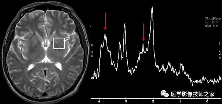 一文读懂!磁共振波普(mrs)检查
