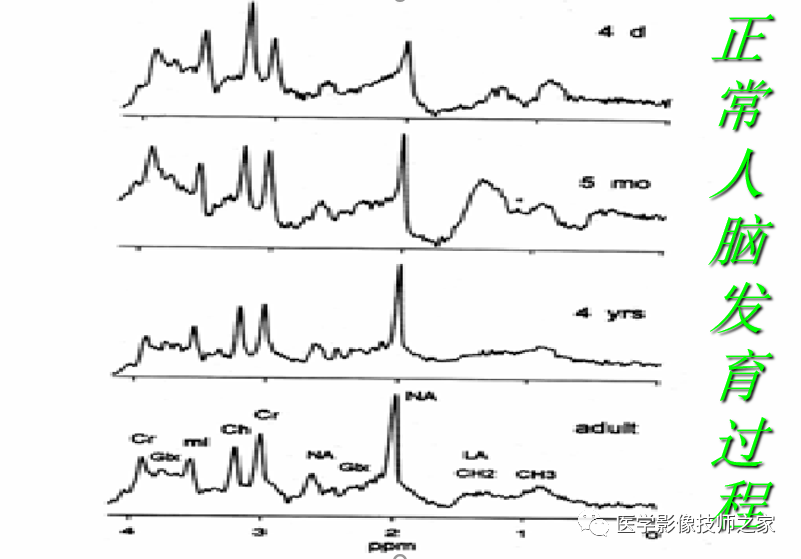 一文读懂!磁共振波普(mrs)检查