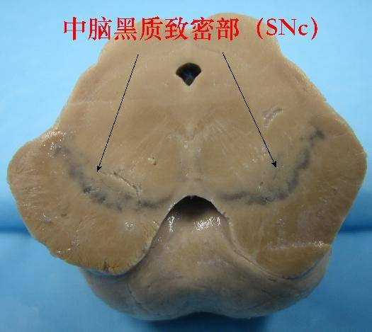 镇静剂|治疗帕金森：大脑深处，一颗核桃大小的谜团