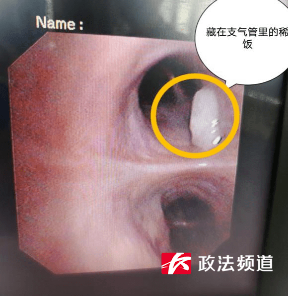 气道|一碗稀饭下肚,49岁男子呼吸衰竭住进ICU!这几种情况要注意