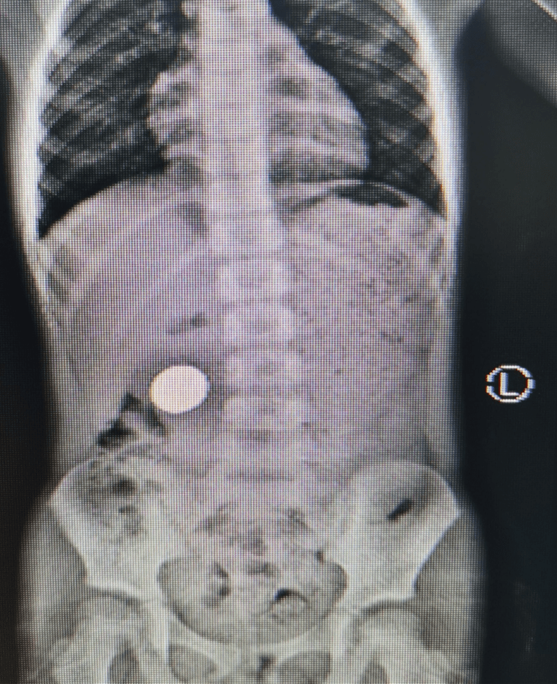 开腹|熊孩误吞硬币1年，还不在胃里？深圳这家医院“探囊取物”