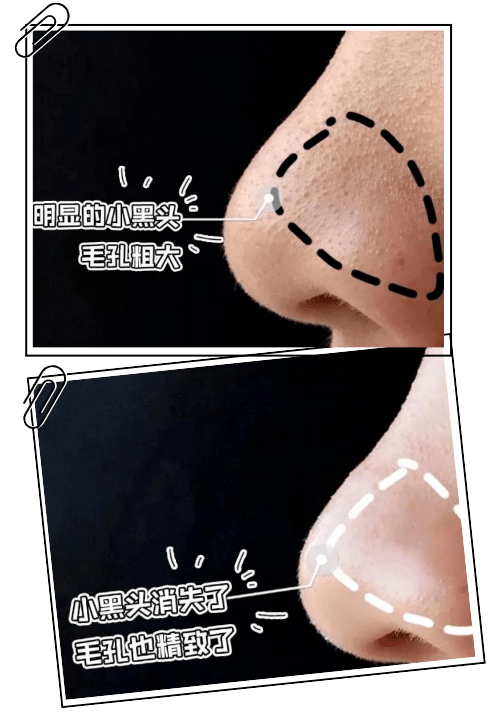 黑头|这张脸，我看了就想吐