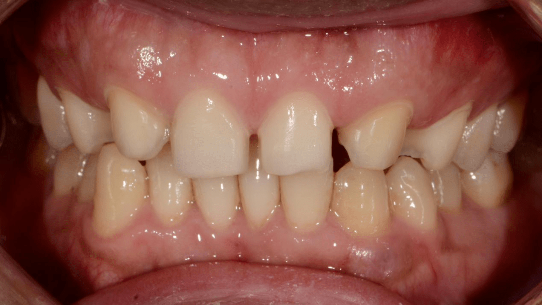 病例前牙烤瓷贴面修复一例