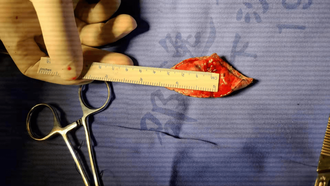 很小的肺结节竟确诊为肺癌切它更不容易