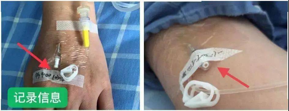 记录穿刺日期时间,穿刺者工号,胶带封住留置针的隔离塞.