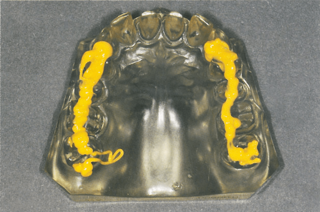 读书笔记瓷嵌体修复季专栏瓷贴面修复技术从标准到微创