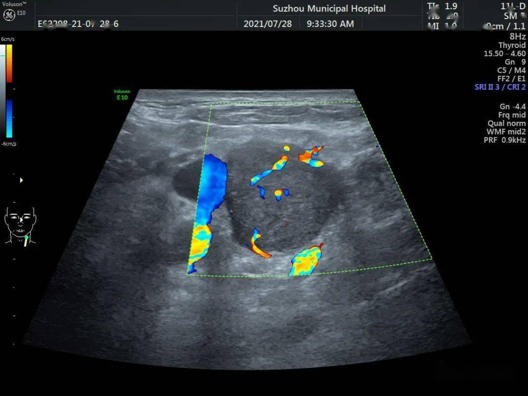 颈部淋巴结转移沙粒状钙化彗星尾征77甲状腺内大部分为良性病变,有