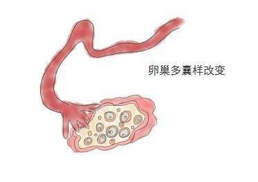 廣泛!雙側多囊卵巢懷孕幾率有多大