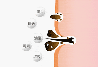 油脂|新西兰百年历史“污垢吸铁石”，15分钟告别黑头、粉刺、闭口