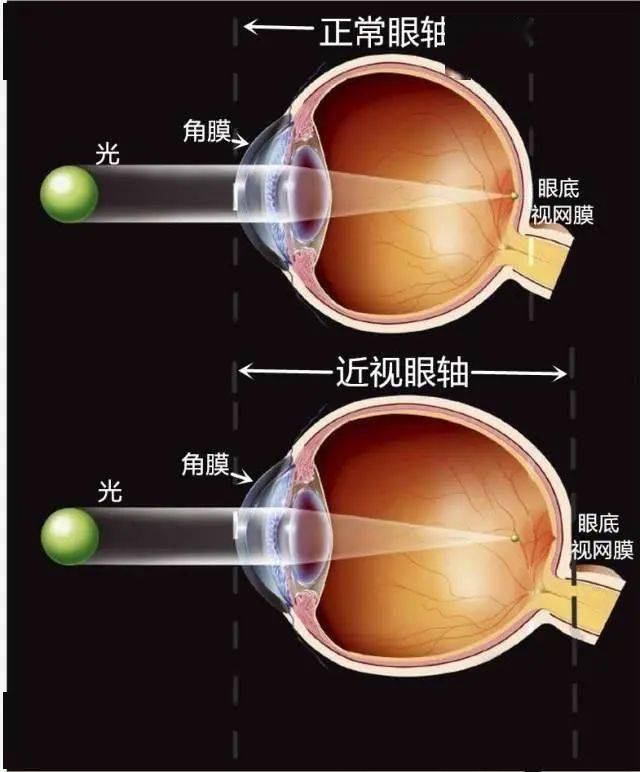 近视眼的成像原理图解图片