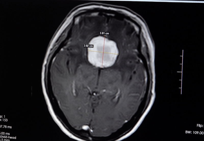 肿瘤|脑肿瘤挤占视神经致左眼几近失明，这个区域的良性瘤也伤眼