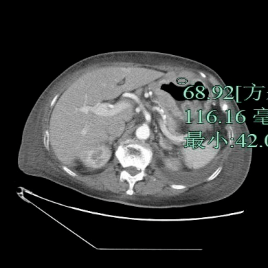 直肠|「放射沙龙Spark病例挑战41期」女性，87岁，因咳嗽气急1周、入院
