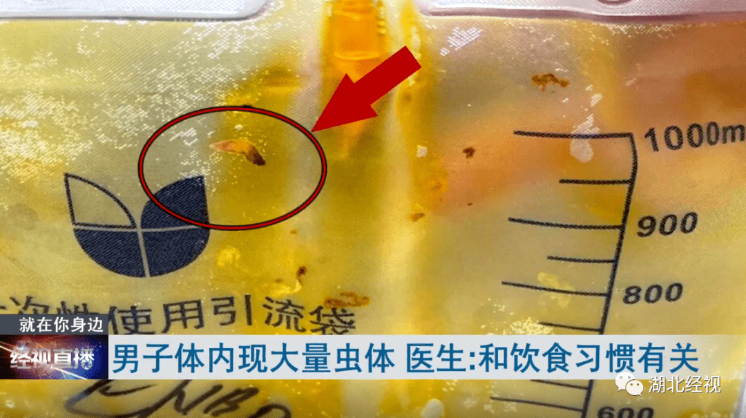 男子|男子体内出现大量活寄生虫！和这种饮食习惯有关