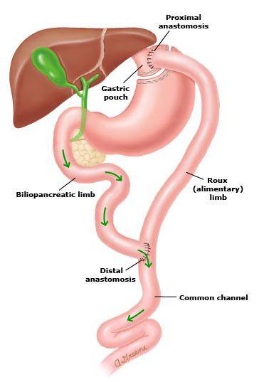 UpToDate|为了减肥切掉胃，不是偷懒，是救命