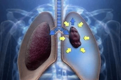 针灸|惊险！广州阿婆自行针灸，针断腹中！医生：擅自针灸有风险