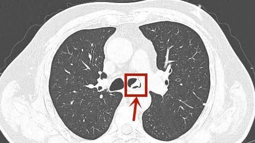 冷报|消失的假牙钩在气管上，老人“心肺都要咳出来”！这些动作不要做