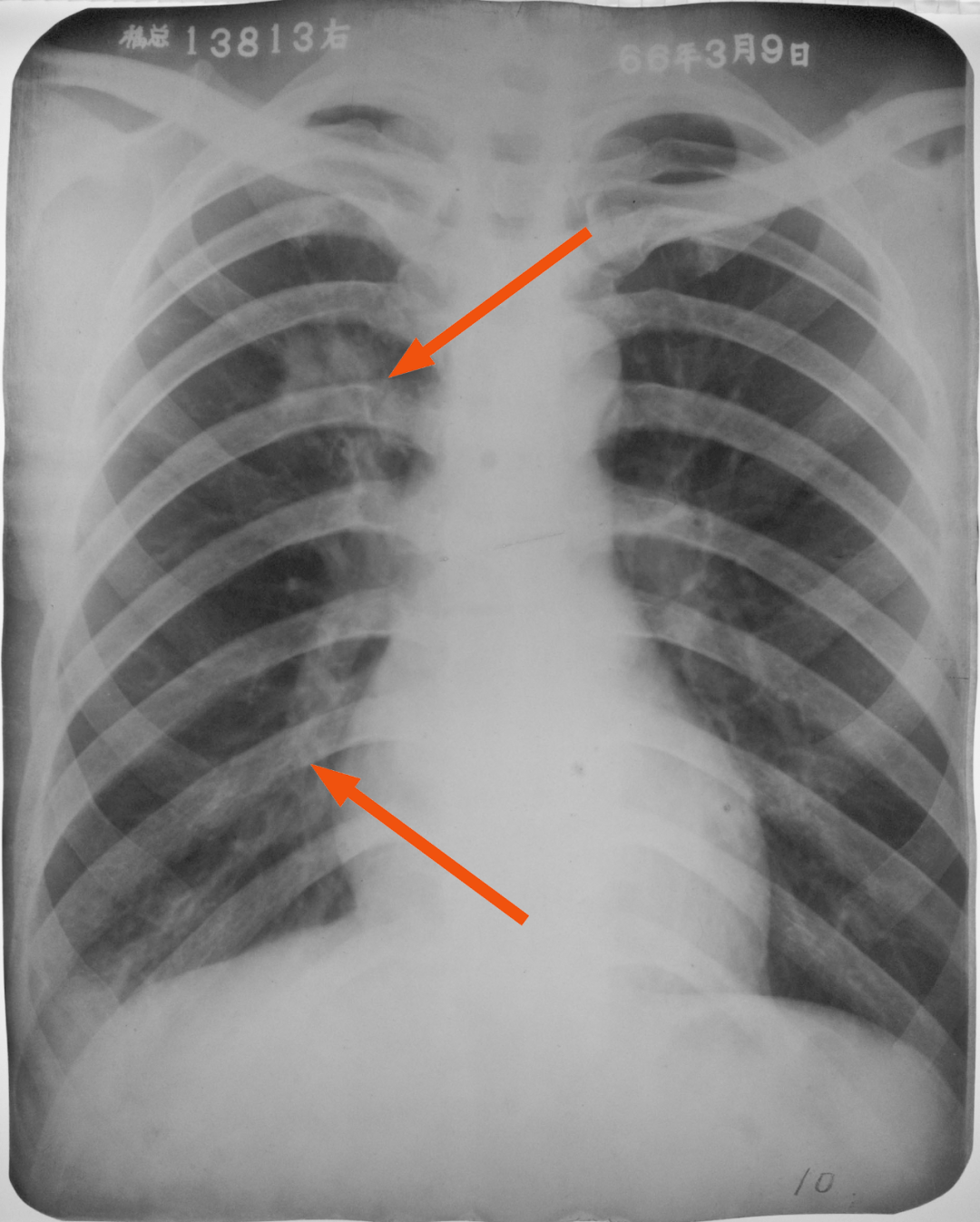 肺炎的片子图片图片