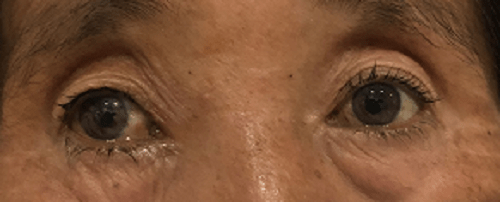 眼眶|眼科大咖领衔，爱尔眼科成都三院联合为患者拆除眼眶“炸弹”