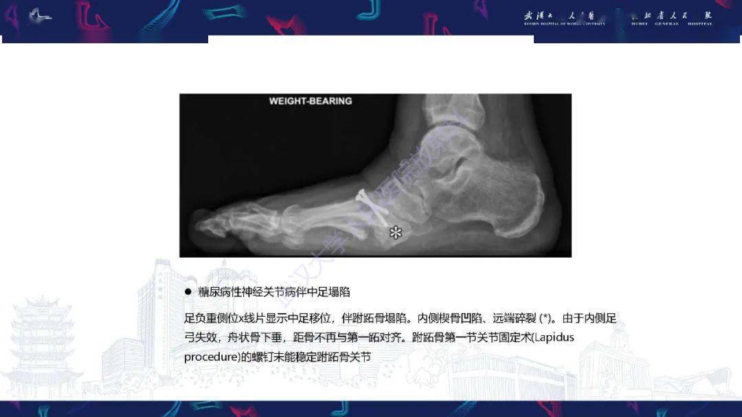 成人获得性扁平足畸形: 解剖学,生物力学,分期和影像学表现