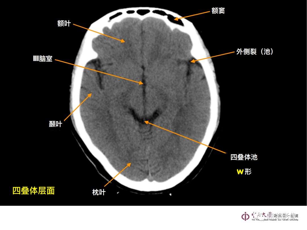 脑的ct解剖结构图图片