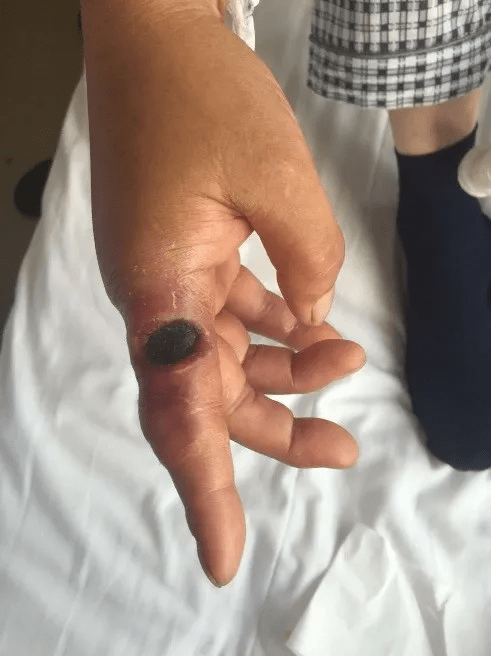 北京市报告1例外地来京就诊肺炭疽病例已隔离治疗