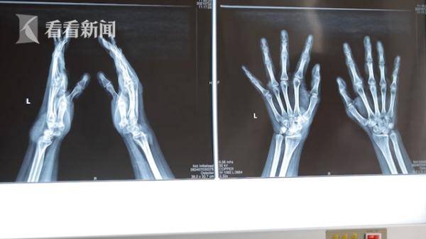 关节|常吃麻辣烫喝甜饮 19岁小伙全身遍布15处“痛风石”