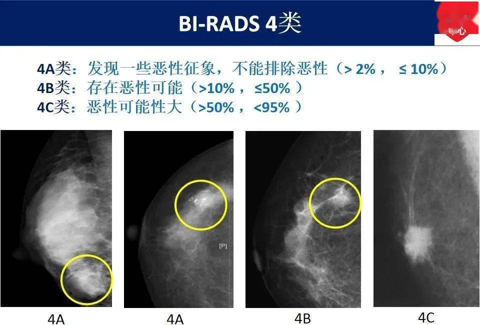 最新版乳腺x線birads分類解讀