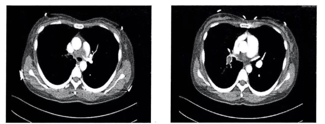 这样的充盈缺损是肺栓塞