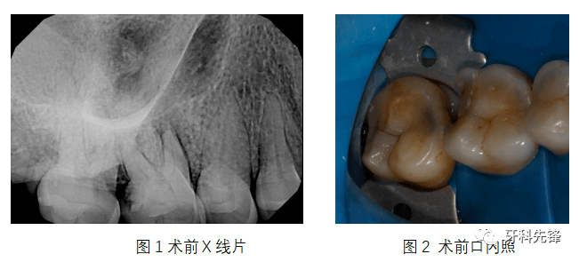 【病例】基于龋损位置设计开髓洞型的上颌第二磨牙根管治疗