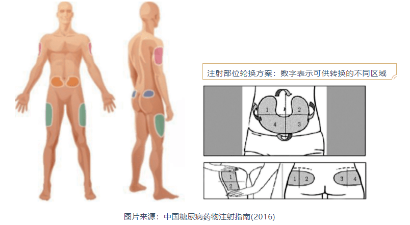 走出胰島素使用誤區你需要知道這些