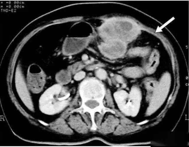 大网膜和小网膜的正常解剖及病变