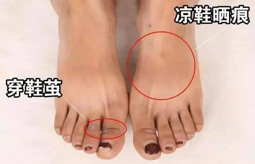 腳背黑一道白一道,腳丫子起 大塊的 死皮