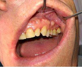 牙槽骨增生有的人磨牙,吱吱作响,感jio声音可以穿透房顶;有的人磨牙