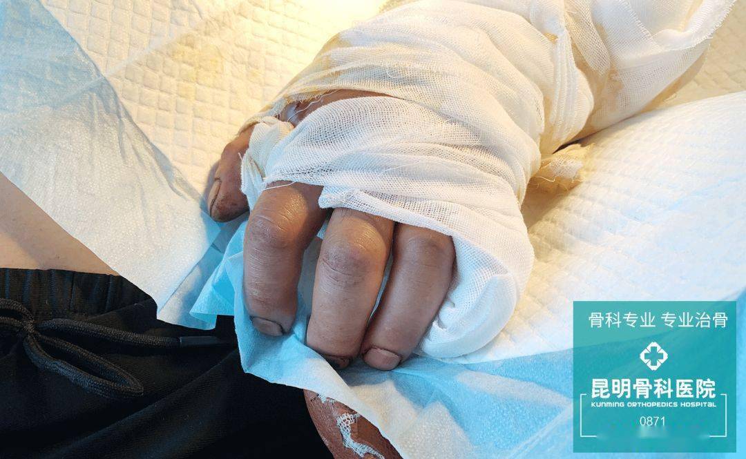 断臂,活了!昆骨,优秀!