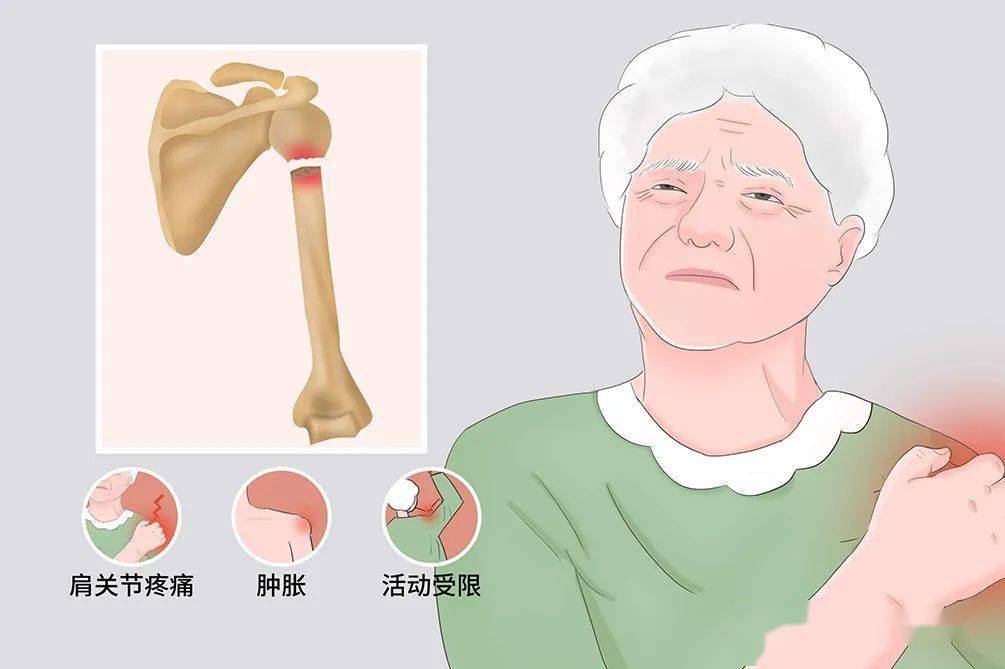 正常的肱骨上端由較緻密的網狀骨松質骨小梁構成,其強度大於關節囊及