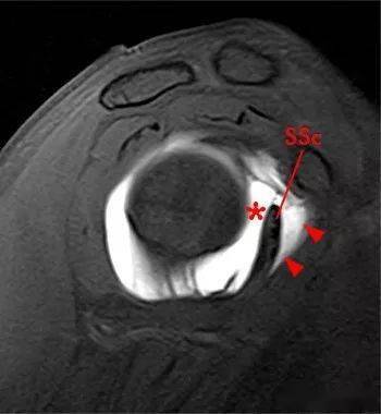 图解肩关节周围滑囊