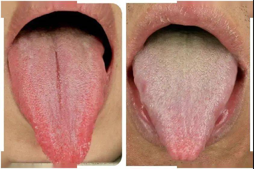 舌头尖,舌尖和舌边发红