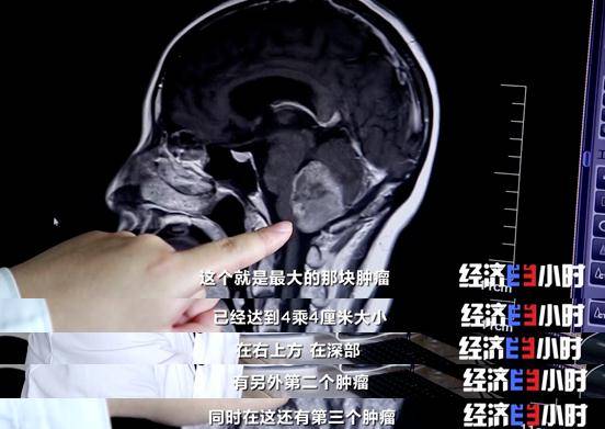 技术|重大利好！不开颅治疗脑肿瘤，费用预计为国外的5%！