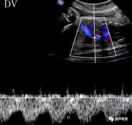 静脉导管a波反向图片