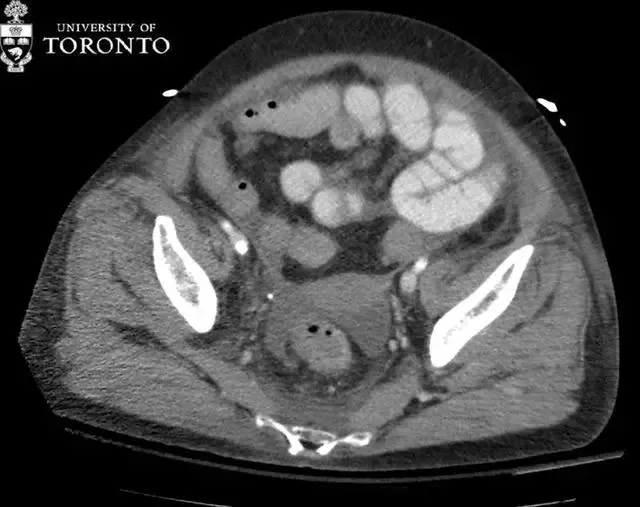 治疗|精选病例:典型的急性坏死性胰腺炎