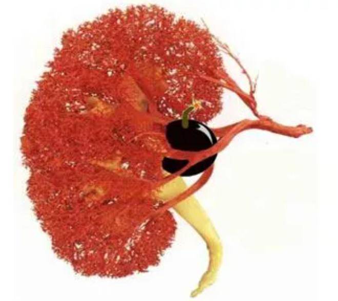 肾脏|五旬阿姨查出巨大肾动脉瘤，广州医生采用微创介入技术拆除