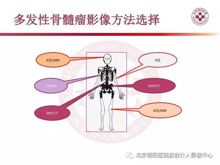 多发性骨髓瘤的影像诊断价值