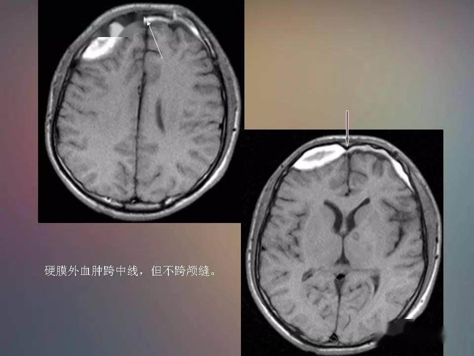 急性重型颅脑损伤图片图片