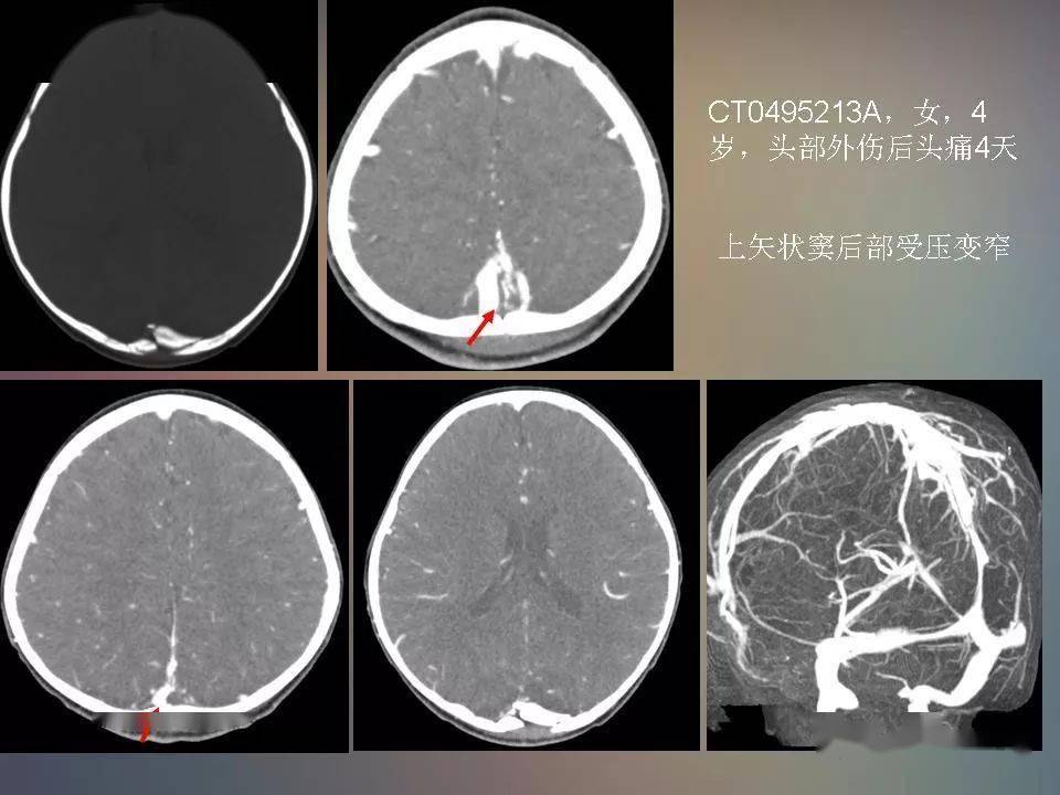 常見的急性顱腦損傷的ct和mri表現