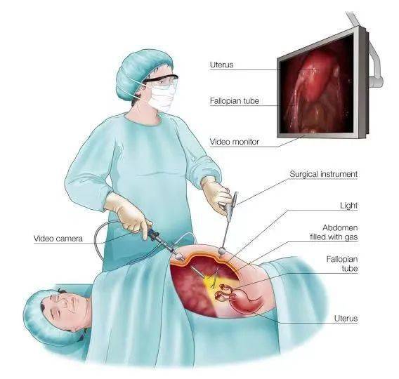 腹腔镜手术动画图片图片