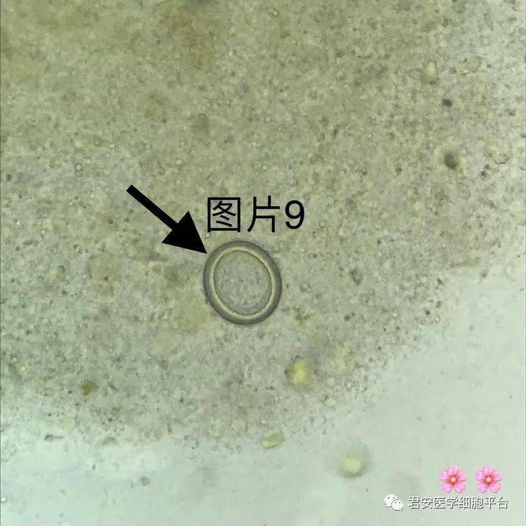 长膜壳绦虫卵图片