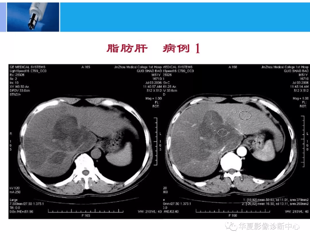 肝脏分段8段CT图图片